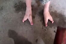 Chang Chang nasceu com apenas dois dedos em cada pé