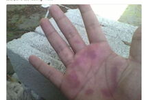 Jovens queimados com sal e gelo no novo desafio da Internet