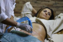 Tratamento ajuda nas estrias