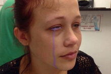 Jovem ficou com o olho roxo