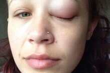 Jovem ficou com o olho roxo