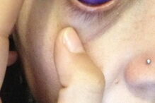 Jovem ficou com o olho roxo