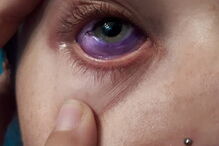 Jovem ficou com o olho roxo