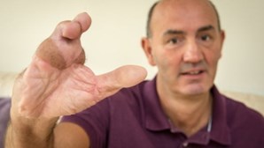 Homem substitui dedos da mão pelos dos pés após acidente
