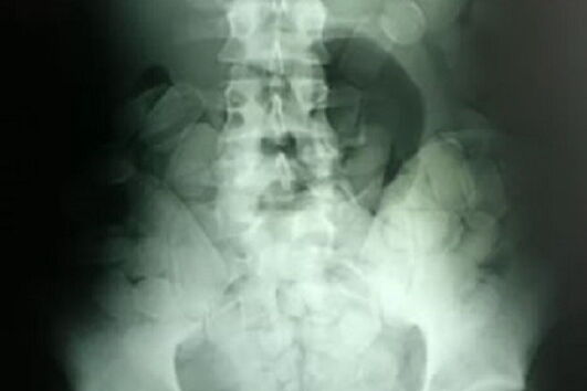 Homem engole 104 cápsulas de cocaína