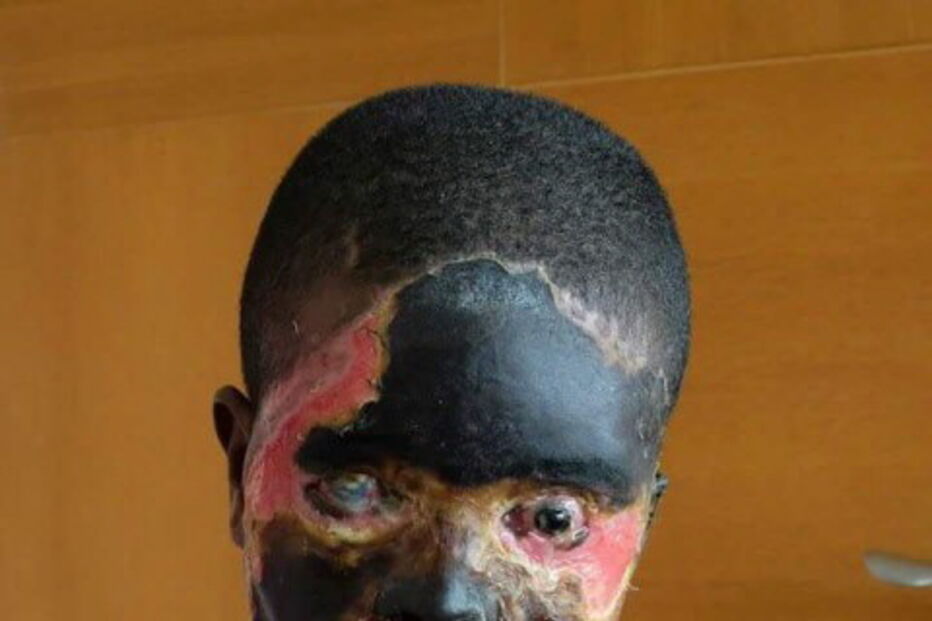 Atsede foi atacada com ácido pelo marido