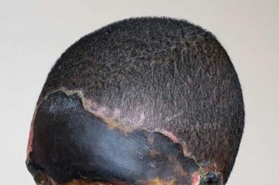 Atsede foi atacada com ácido pelo marido