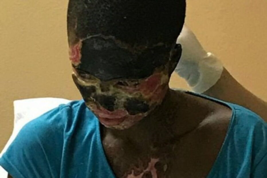 Atsede foi atacada com ácido pelo marido