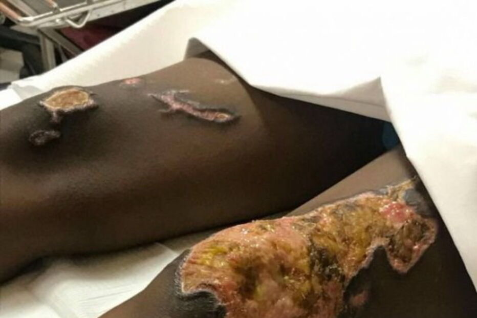 Atsede foi atacada com ácido pelo marido