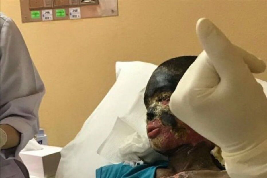 Atsede foi atacada com ácido pelo marido