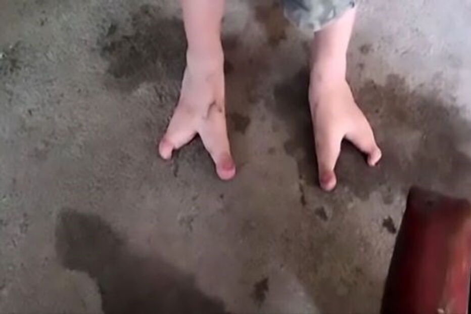 Chang Chang nasceu com apenas dois dedos em cada pé