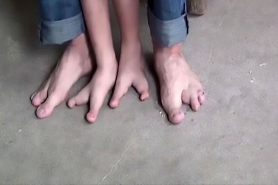 Chang Chang nasceu com apenas dois dedos em cada pé