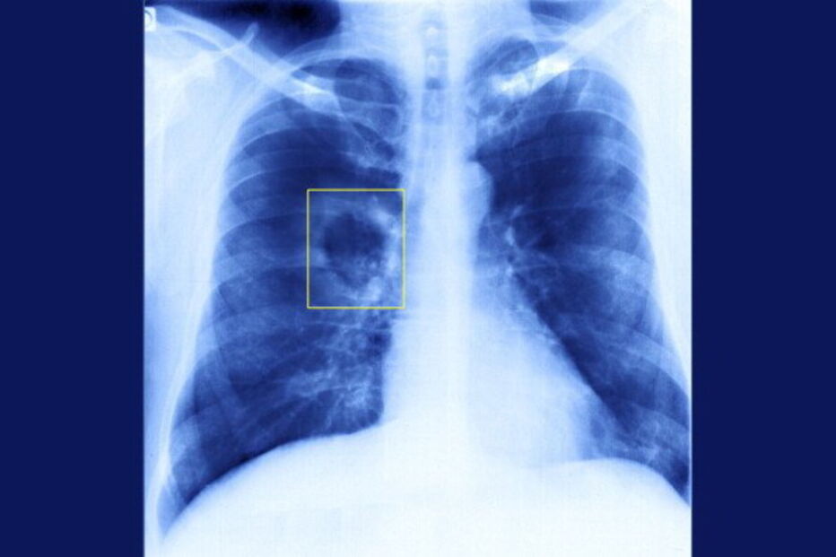 Doenças respiratorias crónicas