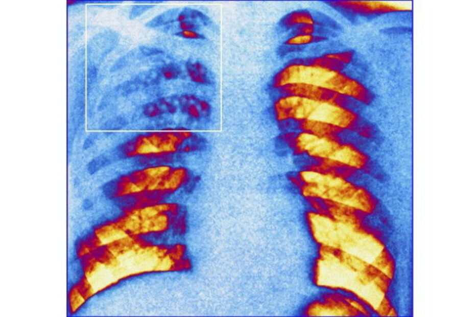 Doenças respiratorias crónicas