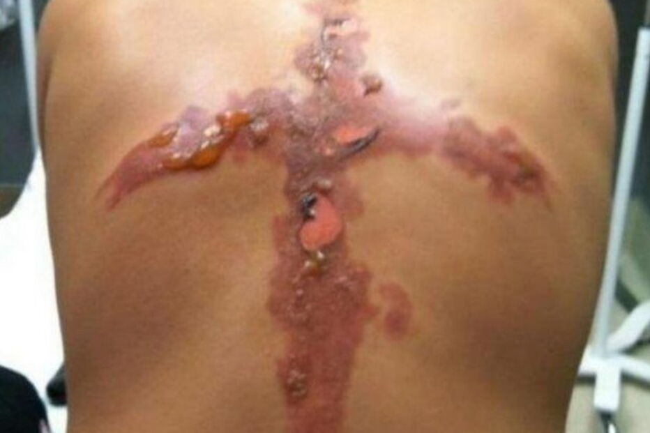 Jovens queimados com sal e gelo no novo desafio da Internet