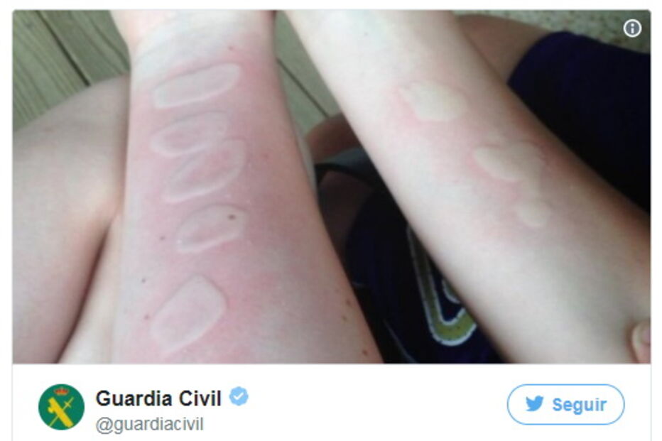 Jovens queimados com sal e gelo no novo desafio da Internet