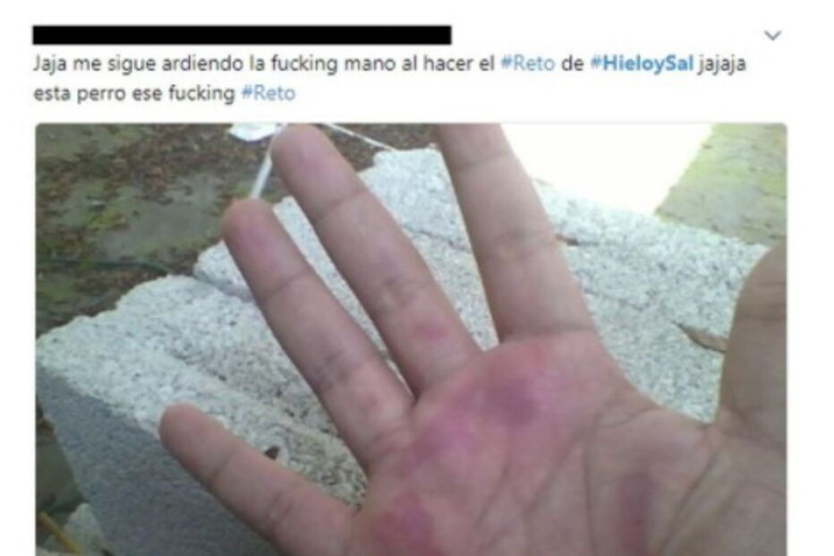 Jovens queimados com sal e gelo no novo desafio da Internet