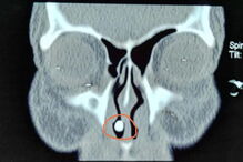 Mulher chinesa tinha dente no interior do nariz