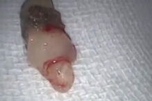 Mulher chinesa tinha dente no interior do nariz