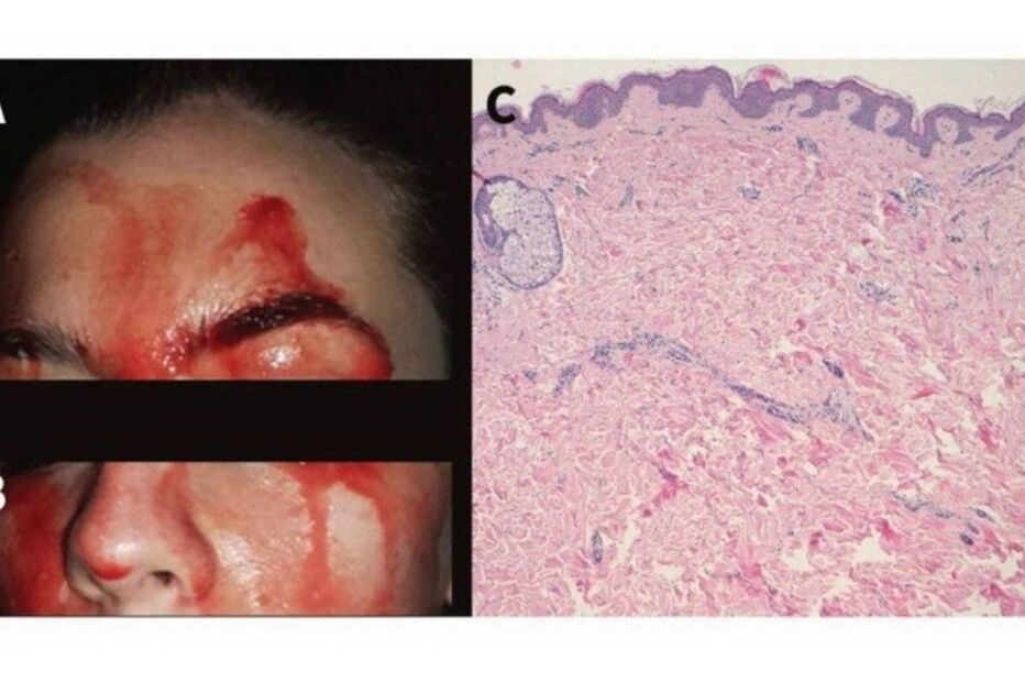 itália, florença, hematidrose, sangue, sua, transpira