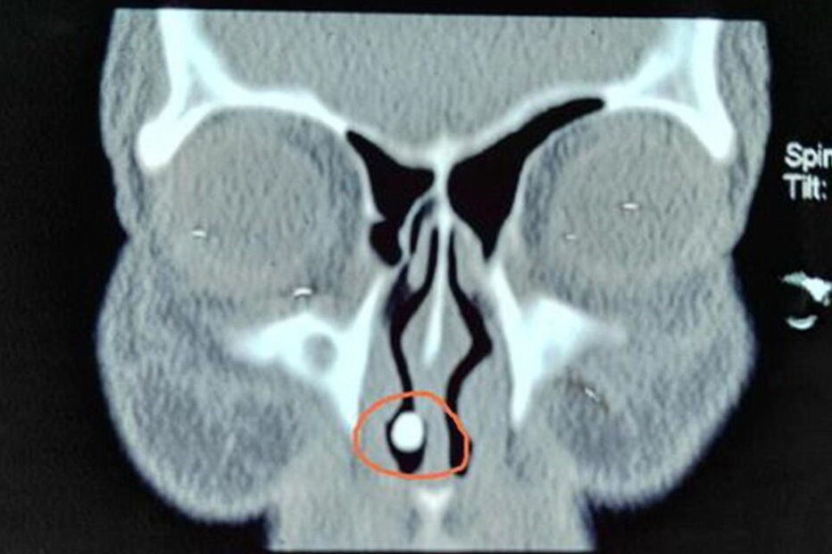 Mulher chinesa tinha dente no interior do nariz