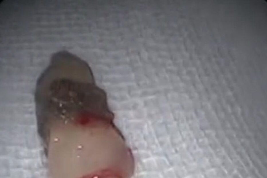 Mulher chinesa tinha dente no interior do nariz