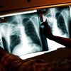 Deteção da Tuberculose está mais difícil devido à pandemia