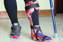 operação, Educação Física, transplante, cartilagens, tornozelo, queda, Matilde Nunes, Pinhal de Frades, Seixal