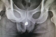 Homem vai ficar com sequelas permanentes depois d eter inserido cadeado na uretra