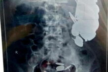 Médicos retiram centenas de agulhas e moedas de estômago de doente