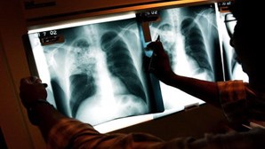 Tuberculose atinge mais crianças e número de casos está a aumentar