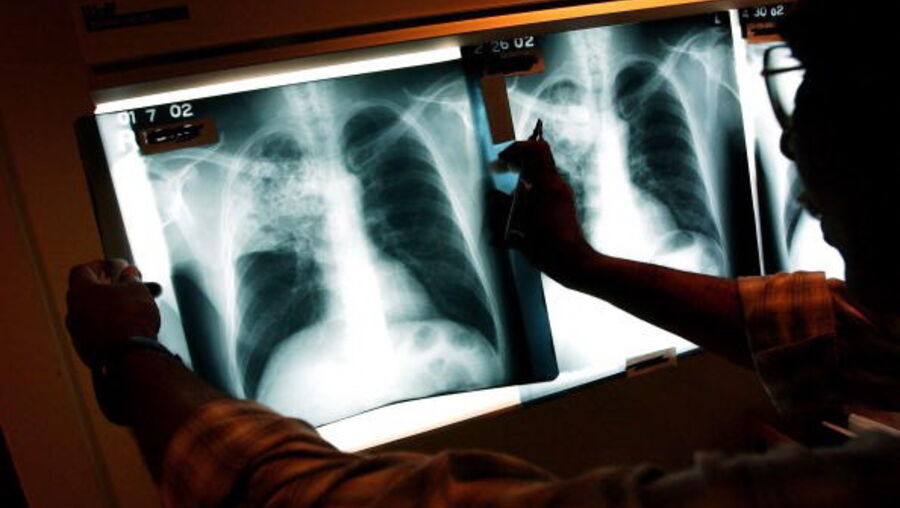 Tuberculose
