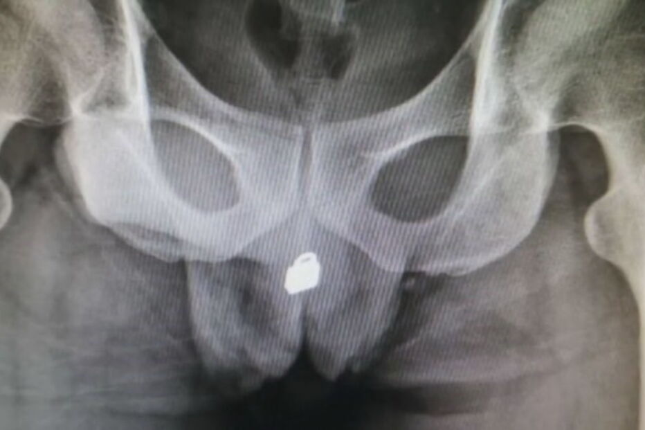 Homem vai ficar com sequelas permanentes depois d eter inserido cadeado na uretra