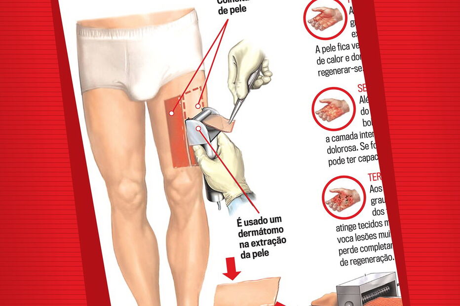 2017-11-24_02_04.23 Bolacha_TransplantePele.jpg