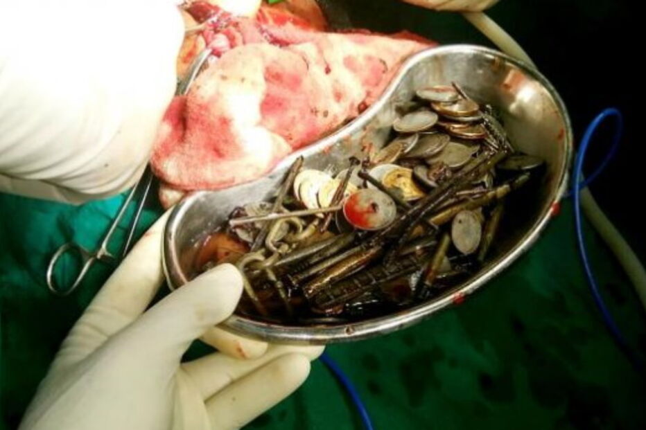 Médicos retiram centenas de agulhas e moedas de estômago de doente