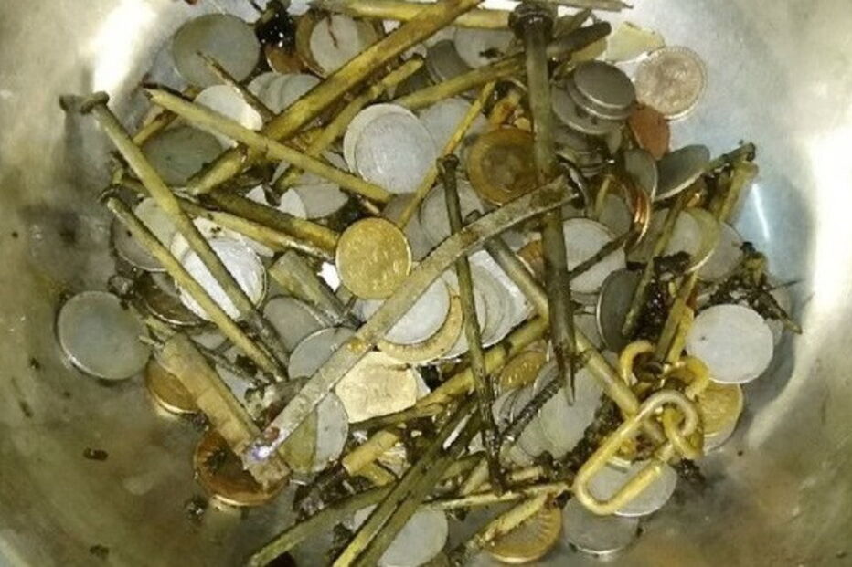 Médicos encontram 263 moedas e 100 pregos em estômago de paciente