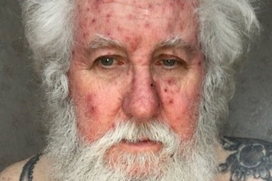 O Pai Natal Dave Upson está com varicela e foi obrigado a 'cancelar' o Natal