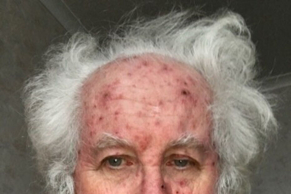 O Pai Natal Dave Upson está com varicela e foi obrigado a 'cancelar' o Natal