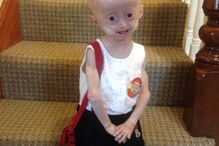 Morreu Lucy, a menina com doença rara que a fazia envelhecer oito vezes mais rápido