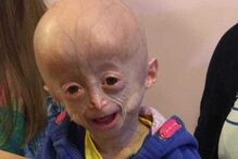 Morreu Lucy, a menina com doença rara que a fazia envelhecer oito vezes mais rápido