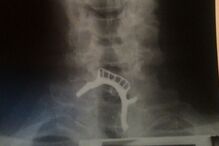 Homem ficou com prótese dentária entalada na garganta durante 40 horas