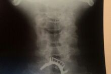 Homem ficou com prótese dentária entalada na garganta durante 40 horas