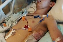 Adolescente em estado crítico após comer sandes mista