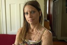 Libby Huffer, doença, tumor, EUA