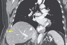 Mulher parte as costelas ao tossir compulsivamente