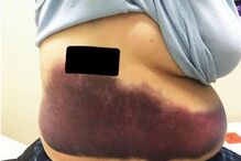 Mulher parte as costelas ao tossir compulsivamente