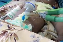 Bebé de 11 meses tinha 16 agulhas dentro do corpo