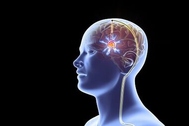 Doença de Parkinson