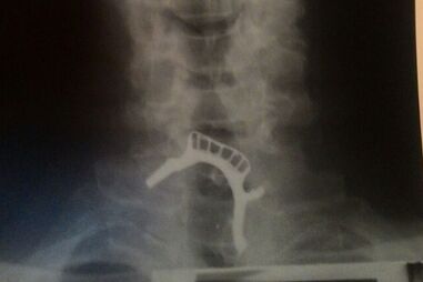 Homem ficou com prótese dentária entalada na garganta durante 40 horas