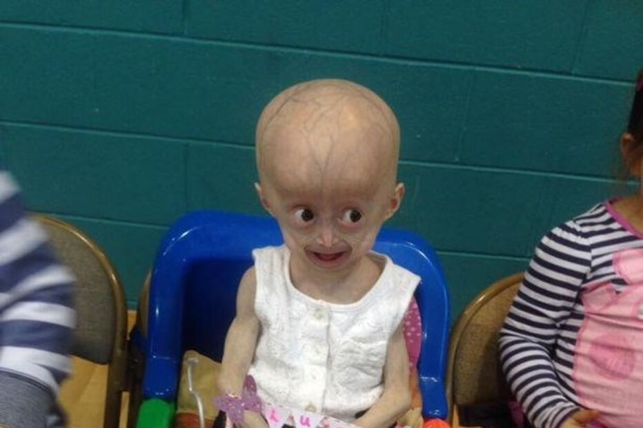 Morreu Lucy, a menina com doença rara que a fazia envelhecer oito vezes mais rápido